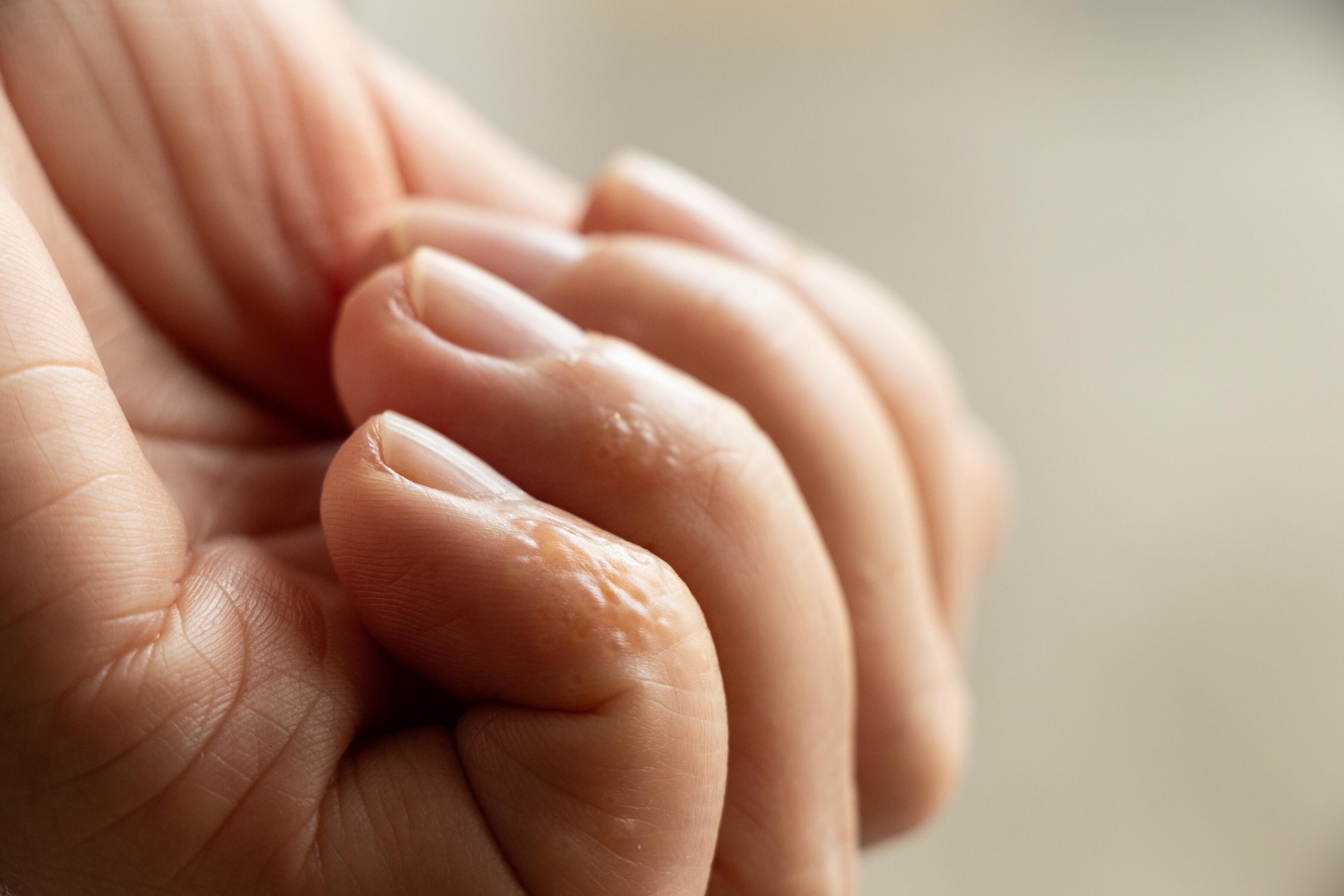 eczema bolloso